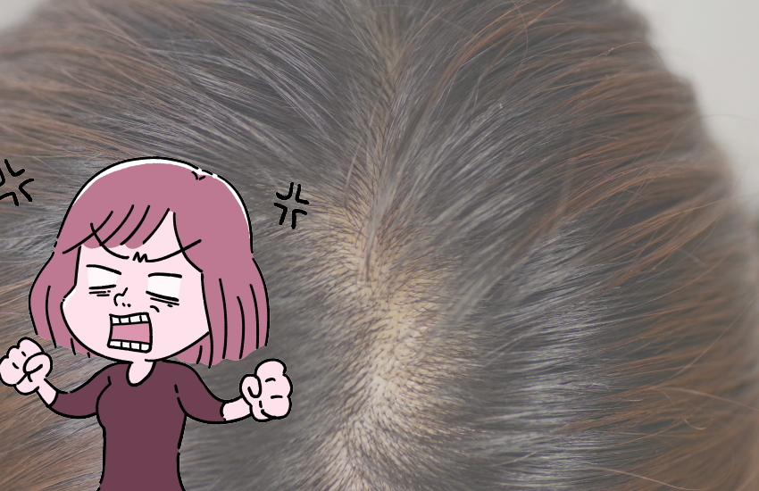 ストレスで急に髪が薄くなった女性